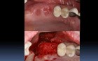Socket Grafting 101 Part A