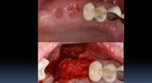 Socket Grafting 101 Part A