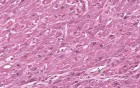 Squamous cell carcinoma