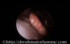 Laryngeal Oedema Due To Hypersensitivity Reaction