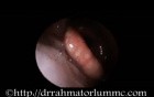 Laryngeal Oedema Due To Hypersensitivity Reaction