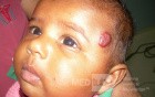 Haemangioma Of The Scalp