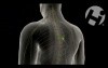 Epidural Catheter and Abscess