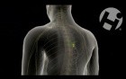 Epidural Catheter and Abscess