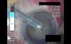 Cataract Surgery - Part 2