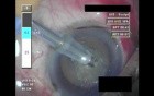 Cataract Surgery - Part 2