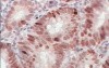 Early Gastric Cancer (20 of 21)