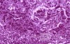 Gallbladder Adenocarcinoma and litiasis (13 of 13)