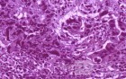 Gallbladder Adenocarcinoma and litiasis (13 of 13)