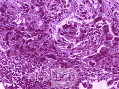 Gallbladder Adenocarcinoma and litiasis (13 of 13)