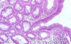 Sessile Tubulovillous Adenoma  (13 of 13)