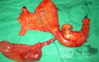 Resected Gut With Cyst
