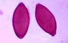 Colonoscopy observing a trichuris in the cecum (5 of 8)