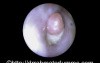 Retained Q-Tip Cotton in The Ear Passage