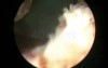 Greenlight HPS Prostatectomy - Part 2
