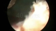Greenlight HPS Prostatectomy - Part 2