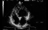 LV Noncompaction