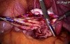Ovarian Endometrial Cyst Removal