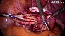 Ovarian Endometrial Cyst Removal