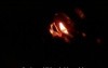 Balloon Sphenoid Sinuplasty