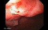 Adenocarcinoma of the Lesser Curvature with Signet Ring Cells (3 of 8)
