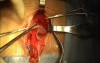 Inguinal hernia repair video