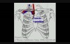 Transcervical Approach For Resection Of Lung Tumors Invading The Thoracic Inlet Sparing The Clavicle