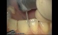 Initial Preparation For Aesthetic Veneers (1/4)
