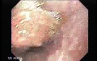 Distal Esophageal Squamous Cell Carcinoma - Esophagoscopy