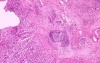 Diffuse Adenocarcinoma with signet ring cells (17 of 18)