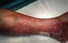 Atrophic Lower Leg Ulceration - Stage III