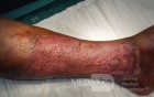 Atrophic Lower Leg Ulceration - Stage III
