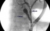 Choledocolithiasis (ERCP)