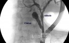Choledocolithiasis (ERCP)