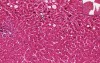 Cholestasis