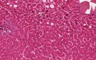 Cholestasis