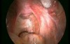 Laparoscopy video