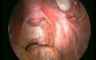 Laparoscopy video