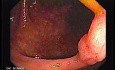 Sessile Tubulovillous Adenoma (2 of 11)