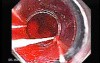 Esophageal Varix - Banding of Two Bleeding Varices