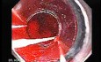 Esophageal Varix - Banding of Two Bleeding Varices