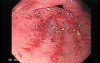 Watermelon Stomach
