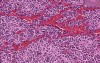 Adrenal - Neuroblastoma
