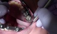 Prevent Rmgi From Sticking To Your Instruments