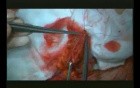Right Open Hemicolectomy – Technical Principles - Part 4