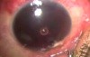 Traumatic Hemopthalmus - Microtrack Filtration