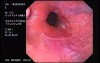 Banding of esophageal varices - insertion of the endoscope