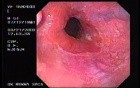 Banding of esophageal varices - insertion of the endoscope