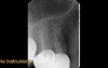 Instrument removal technique - surgical video