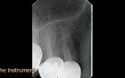 Instrument removal technique - surgical video